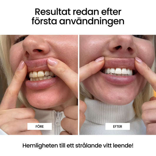 GLACR® | Whitening Strips